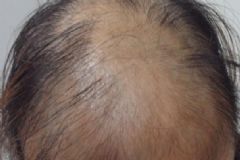 頭發(fā)稀疏掉發(fā)怎么辦？頭發(fā)稀疏掉發(fā)如何緩解？[圖]