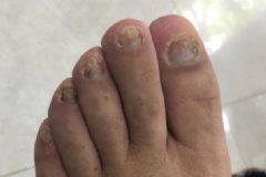 如何預(yù)防灰指甲？得了灰指甲怎么辦？[圖]