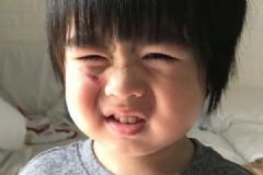 林志穎兒子跌傷臉，跌傷后如何處理？[多圖]