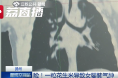 被親戚喂花生米嗆進(jìn)氣管，寶寶吃東西嗆到氣管怎么辦？[多圖]