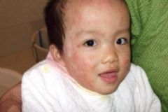 寶寶過敏有什么癥狀？六大容易被忽視的過敏癥狀？[圖]