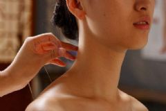 針灸要如何減肥？針灸對(duì)女人有何好處？[圖]
