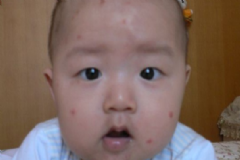 嬰兒臉上起小紅點怎么回事？嬰兒臉上起小紅點怎么辦？[圖]