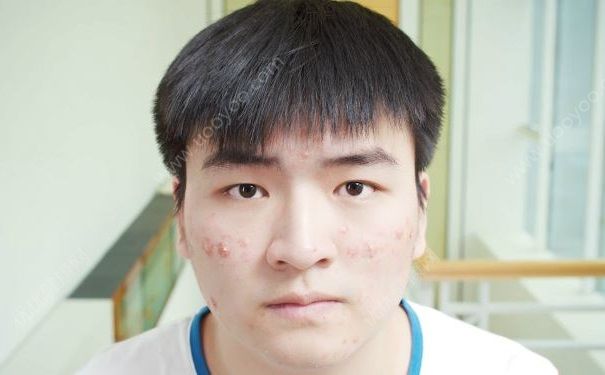 擠顆痘痘致器官衰竭，整整搶救5天，兩下病危通知(2)