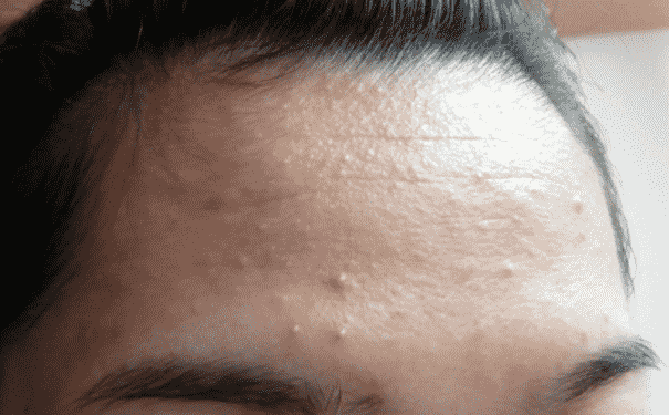 各個(gè)部位的痘痘怎樣去除？如何去除不同部位的痘痘？(1)