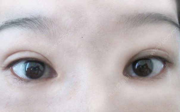 埋線雙眼皮有何危害？埋線雙眼皮有何優(yōu)缺點(diǎn)？(1)