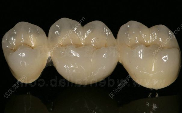 純鈦烤瓷牙多少錢？如何延長(zhǎng)純鈦烤瓷牙的壽命？(1)