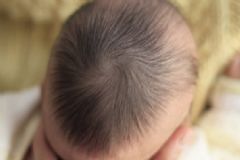 寶寶枕禿是怎么回事？出現(xiàn)枕禿一定是缺鈣嗎？[圖]