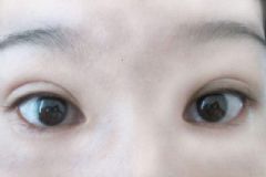 埋線(xiàn)雙眼皮有何危害？埋線(xiàn)雙眼皮有何優(yōu)缺點(diǎn)？[圖]