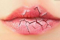 孕婦嘴干起皮的原因是什么？孕婦嘴干脫皮怎么辦？[圖]