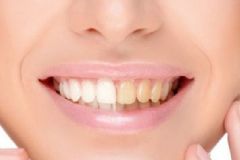 吃什么會導(dǎo)致牙齒變黃？哪些食物吃了會導(dǎo)致牙齒變黃？[多圖]