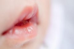 寶寶秋季嘴唇干燥怎么辦？如何預(yù)防寶寶嘴巴脫皮？[圖]