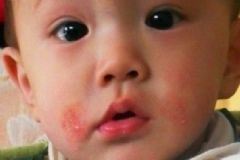 天氣熱全身發(fā)癢怎么辦？天氣熱為什么全身發(fā)癢？[多圖]