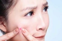 臉上長痘吃什么好？臉上長痘可以吃什么？[圖]