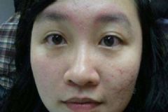 臉上痘痘很多怎么辦？臉上的痘痘很多怎么調(diào)理？[圖]