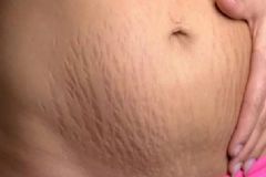 剖腹產(chǎn)后妊娠紋怎么淡化？消除妊娠紋的有效方法有哪些？[圖]