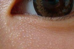 什么是脂肪粒?產(chǎn)生脂肪粒的原因有哪些？[圖]