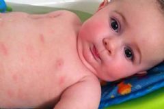 寶寶母乳過敏有哪些癥狀？寶寶母乳過敏有什么癥狀？[圖]