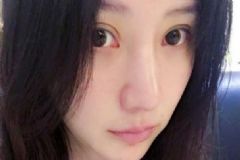 切開雙眼皮手術(shù)后眼睛多久消腫？切開雙眼皮手術(shù)后如何護(hù)理？[圖]