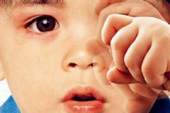 做近視手術(shù)需要什么？做了近視手術(shù)怎么護(hù)理？[圖]