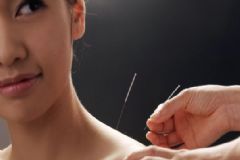 哪些針灸減肥的誤區(qū)要了解？針灸減肥誤區(qū)常見的有哪些？[圖]