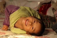 針刀治療痙攣性腦癱效果良好，痙攣性腦癱注意事項(xiàng)[圖]
