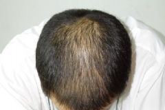 男人脫發(fā)原因有哪些?預(yù)防男性禿頂要怎么做？[圖]