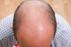 男性禿頂?shù)慕】滴C有哪些？禿頂究竟是什么原因造成的？[圖]