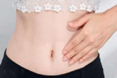 妊娠紋如何去除最快？快速去除妊娠紋的方法有哪些？[圖]