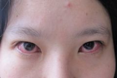 眼睛通紅是什么原因？眼睛通紅是什么病導致的？[圖]