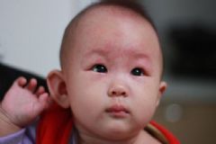 幼兒急疹的癥狀是怎樣的？幼兒急疹該怎樣護理？[圖]
