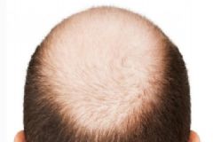 禿頭是什么原因造成的？為什么會(huì)出現(xiàn)禿頭？[圖]