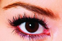 眼睛充血的原因是什么？會(huì)導(dǎo)致眼睛充血有哪些原因？[圖]
