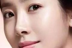眼皮腫是什么原因？眼皮腫有哪些原因？[圖]