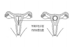 女性結扎手術什么時候做？結扎手術什么時候做最佳？[圖]