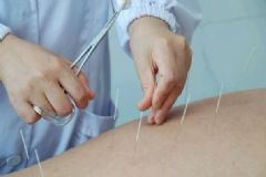 失眠了怎么進(jìn)行中醫(yī)治療？失眠的針灸療法是怎么樣的？[圖]