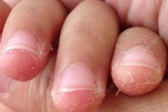 從手是否可以了解身體健康狀況？手脫皮應該如何保養(yǎng)？[圖]