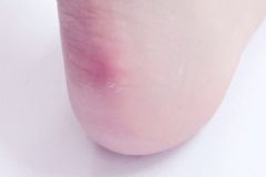 腳后跟掉皮是什么原因？腳跟脫皮是怎么回事？[圖]