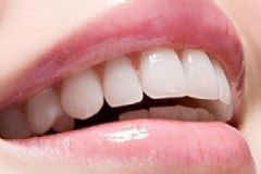 冷光美白牙齒能保持多長時間？冷光美白牙齒能管多久？[圖]