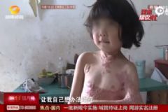 女孩燙傷成蝙蝠臂，燙傷后怎么辦？[多圖]