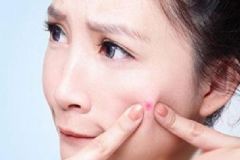 什么護(hù)膚品祛痘最好？祛痘最好的護(hù)膚品？[圖]