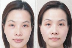 眼窩凹陷是哪些原因引起的？如何矯正眼窩凹陷？[圖]