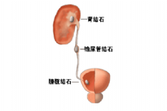 膀胱結(jié)石手術(shù)治療會有效嗎？膀胱結(jié)石手術(shù)治療的效果[圖]