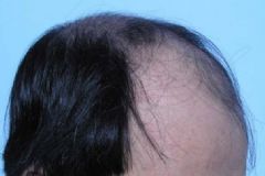 男性脫發(fā)能治好嗎？男性脫發(fā)怎么辦？[圖]