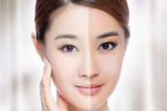 黃褐斑有哪些危害？黃褐斑如何治療？[圖]