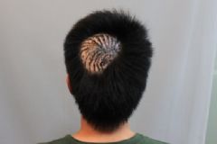 植發(fā)能解決脫發(fā)嗎？植發(fā)能維持多久？[圖]