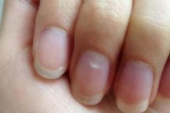 為什么指甲上會有白點？指甲上有白點的原因是什么？[圖]