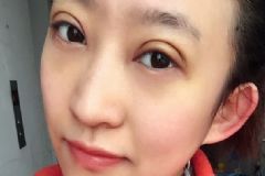 割雙眼皮后注意些什么？割雙眼皮后的注意事項[多圖]