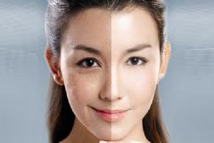 祛斑效果最好的方法是什么？祛斑小妙招[多圖]