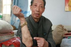 脂肪瘤疼痛是怎么回事？脂肪瘤痛是怎么回事？[圖]